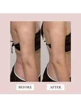 ミーティス/術後ケアのお客様♪