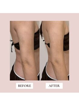 ミーティス/術後ケアのお客様♪