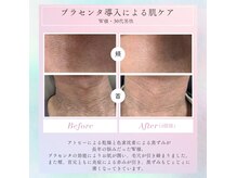 スウィートオリーブ 春日部(SweetOlive)の雰囲気（プラセンタ×エアインジェクトで肌質改善）