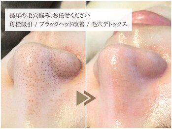 レイテノール 藤沢店の写真/【毛穴詰まりごっそり解消】吸引×角質ケアのダブルアプローチで毛穴レスなつるピカ肌に導きます♪