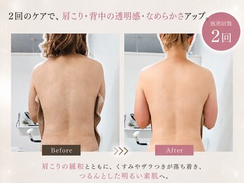オレオマ(OLEOMA)の写真/【寝てるだけで変化】辛い肩こりや盛り上がった肩まわりにサヨナラ