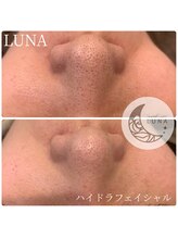 ルーナ(LUNA)/☆ハイドロスキン一回施術結果☆