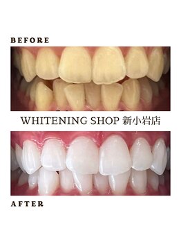 ホワイトニングショップ 新小岩店/1番人気☆フリーパスコース