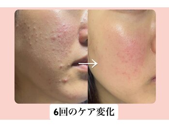 スキンハピネス(skinhappiness)/顔ハーブピーリングケア