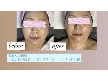 トータルビューティーサロン カノン(Kanon)/小顔コースたった1回の変化写真