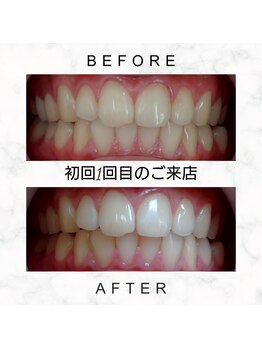 エミリアホワイトニング(EMIRIA WHITENING)/Before/After