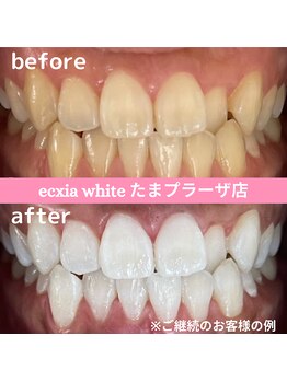 エクシアホワイトニング たまプラーザ店/ビフォーアフター