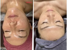 ミュー 新小岩店(Mieux)/セラピール&小顔コルギ5回効果