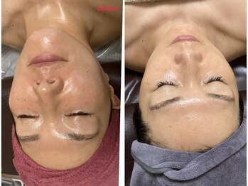 ミュー 新小岩店(Mieux)/セラピール&小顔コルギ5回効果