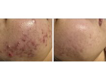 エラン(ELAN)/ニキビ肌質改善【Dr,sハーブ】