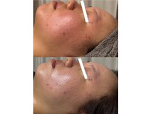 エステ リラクゼーションサロン(more)の雰囲気（敏感肌にも◎春の花粉に負けない！バリア機能を高める陶肌ピール）