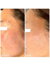 ラヴィアンローズ 岐阜本店(La vie en Rose)/6回のピーリング