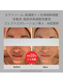 リュクシー(LuxeY)/高濃度ナノ幹細胞でしみ改善