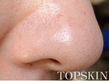 トップスキン 久屋大通(TOPSKIN)/REVI１回でここまで変わります！