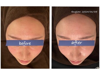 エングロー(Englow)/美肌の定番！ハーブピーリング♪