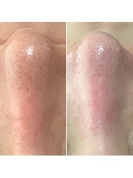 エステティックサロン S/毛穴黒ずみ除去オプション