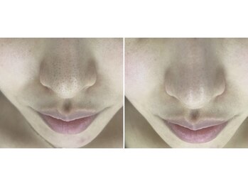 ラ ルアナ(La Luana)/毛穴洗浄でスッキリしましょう！