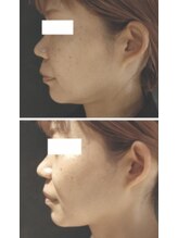 ペリドット(Peridot)/レモンボトル