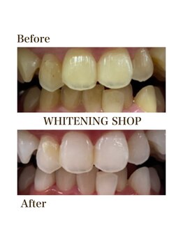 ホワイトニングショップ 川越店/【Before After】