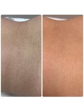 スムース(smooth)/smooth自慢の脱毛