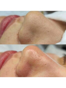 キナビューティー 川崎(Kina Beauty)の写真/【ヒト幹細胞で肌のターンオーバーを促進！】普段のお手入れでは落としきれない毛穴汚れも徹底洗浄☆[川崎]