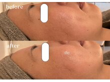 リスタ(RSTA)/【BEFORE/AFTER】