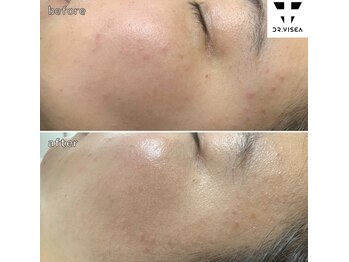 ルミラポー(Lumira Peau)/20代2回