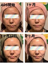 フランジパニ(Frangipani)/【40代】くすみ・ゴワつき悩み