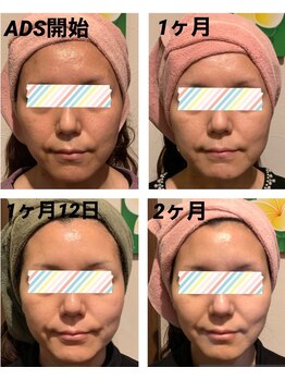 フランジパニ(Frangipani)/【40代】くすみ・ゴワつき悩み