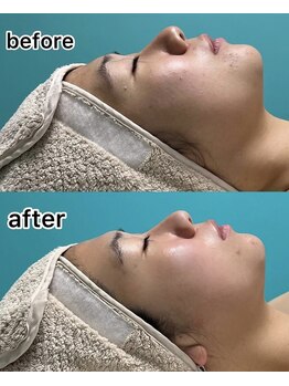 キノ(Kino)/小顔basic