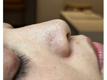 ストック(stock)/毛穴エクストラクション施術前