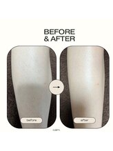 カルム(calm.)/膝下（膝含む）脱毛