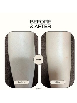 カルム(calm.)/膝下(膝含む)脱毛