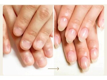 深爪は癖だからと諦めてた