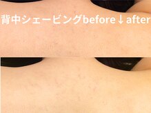 ももとゆでたまご/背中シェービングbefore↓after