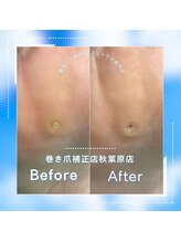 巻き爪補正店 秋葉原店/【硬いタコ/魚の目ケア】