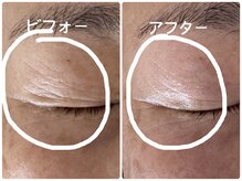 ノーブル シャット Noble Chate/瞼のたるみケア