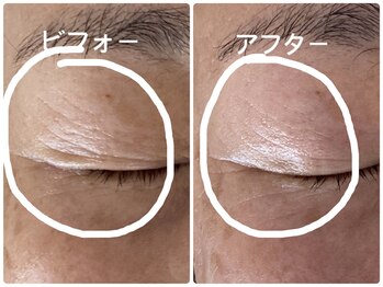 ノーブル シャット Noble Chate/瞼のたるみケア