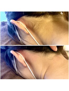 スノーフレーク(snow flake)/ブライダルシェービング◇症例◇