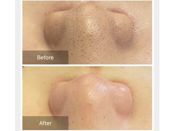 リジュベ(Rejuve)/毛穴エクストラクション[本八幡]