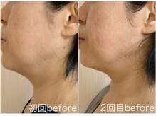 毛穴塾/話題の小顔マイクロリフト