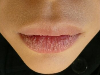 ハーティービーム(Hearty Beam)/ビームオンリップエステ ｂefore