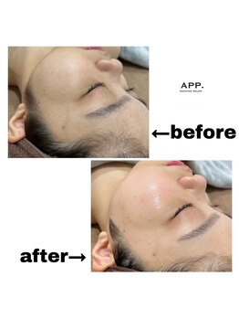 アプ(APP.)/シェービング/脱毛/エステ/小顔