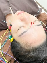 カンナ 福岡(Canna)/美容鍼でくすみ解消★