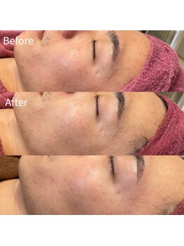 ビトタン 倉敷本店(+美to鍛)/ハーブピーリング1g/2回