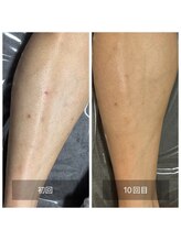 ダンニヒル(dannihil)/【足脱毛】40代会社員10回目