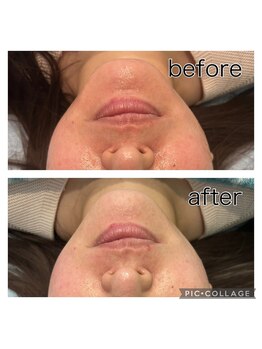 レイモード(Ray mode)/BBLフェイシャル＆パック＆脱毛