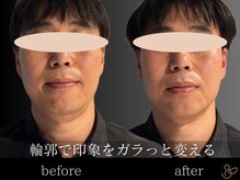 チョコバリ 郡山店(chocobari)/小顔×リフトアップ(美容鍼)20代