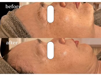 リスタ(RSTA)/【BEFORE/AFTER】