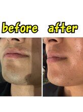 ヤーニング(yearning)/ヒゲ脱毛　変化